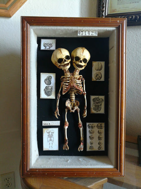 Framed Conjoined Head Fetal Specimen